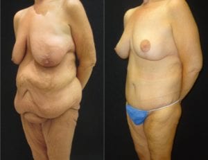 Lower Body Lift - Before And After - Fairfax and Manassas VA