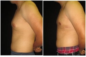 15300b-male-breast-reduction - Male Breast Reduction - Before And After - Gynecomastia - Fairfax and Manassas VA