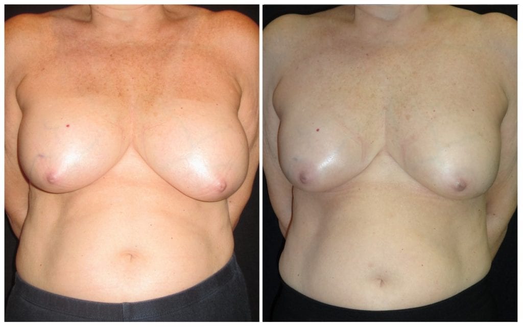 15369a-breast-reduction-liposuction - Breast Reduction Liposuction - Before And After - Fairfax and Manassas VA