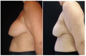 15369b-breast-reduction-liposuction - Breast Reduction Liposuction - Before And After - Fairfax and Manassas VA