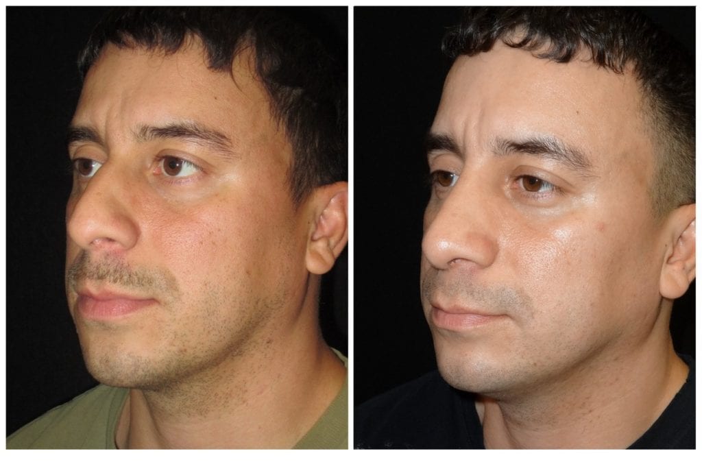 15465a-rhinoplasty-for-men - Rhinoplasty For Men - Before And After | Fairfax and Manassas VA