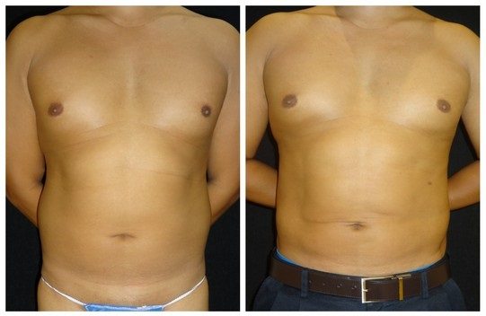 15502a-abdominal-etching - Abdominal Etching - Before And After - Fairfax and Manassas VA