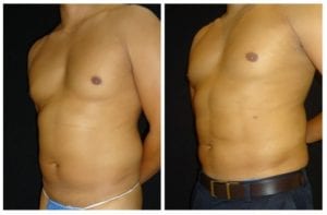 15502b-abdominal-etching - Abdominal Etching - Before And After - Fairfax and Manassas VA