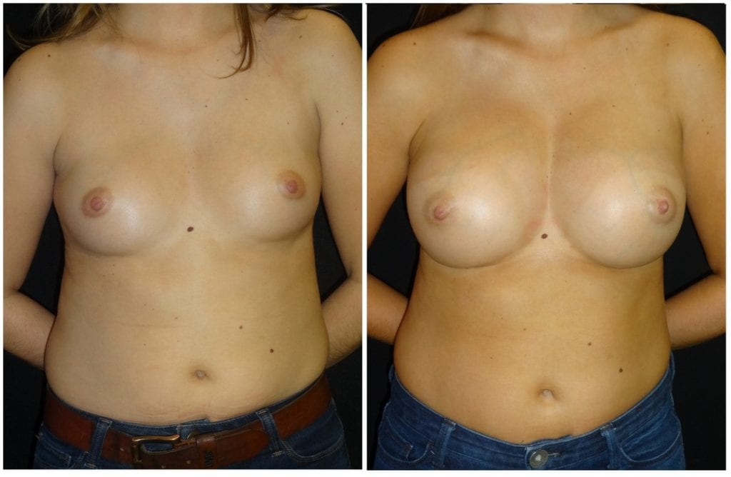 15675a-breast-augmentation - Breast Augmentation Before And After - Fairfax and Manassas VA