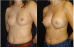 15675b-breast-augmentation - Breast Augmentation Before And After - Fairfax and Manassas VA