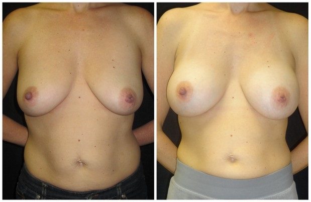 15752aa-breast-augmentation - Breast Augmentation Before And After - Fairfax and Manassas VA