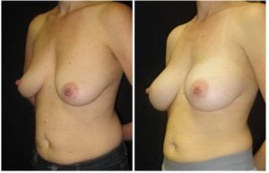 15752bb-breast-augmentation - Breast Augmentation Before And After - Fairfax and Manassas VA