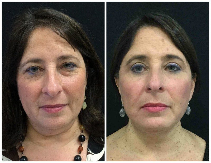 15979aa-eyelid-lift-upper-and-lower - Upper and Lower Eyelid Lift - Before And After - Fairfax and Manassas VA