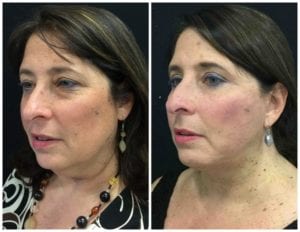 15979bb-eyelid-lift-upper-and-lower - Upper and Lower Eyelid Lift - Before And After - Fairfax and Manassas VA