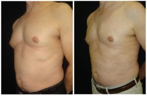 15980b-male-breast-reduction - Male Breast Reduction - Before And After - Gynecomastia - Fairfax and Manassas VA