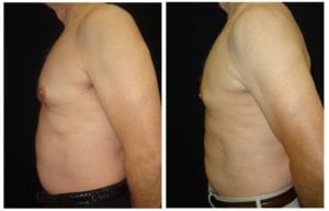 15980c-male-breast-reduction - Male Breast Reduction - Before And After - Gynecomastia - Fairfax and Manassas VA