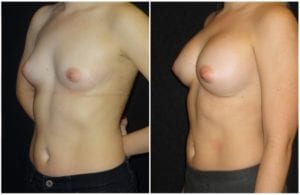 16007bb-breast-augmentation - Breast Augmentation Before And After - Fairfax and Manassas VA