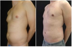 16009b-male-breast-reduction - Male Breast Reduction - Before And After - Gynecomastia - Fairfax and Manassas VA
