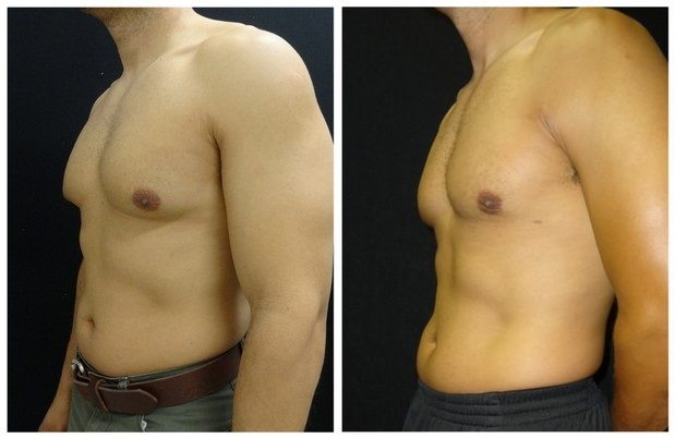 16081a-male-breast-reduction - Male Breast Reduction - Before And After - Gynecomastia - Fairfax and Manassas VA
