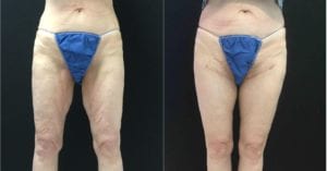 Thigh Lifts Before And After - Fairfax and Manassas VA