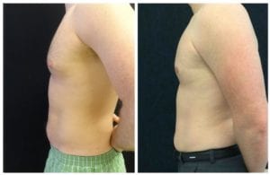 16357b-male-breast-reduction - Male Breast Reduction - Before And After - Gynecomastia - Fairfax and Manassas VA