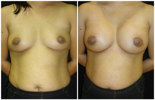 16382a-breast-augmentation - Breast Augmentation Before And After - Fairfax and Manassas VA