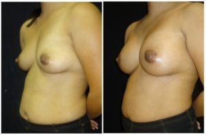 16382b-breast-augmentation - Breast Augmentation Before And After - Fairfax and Manassas VA