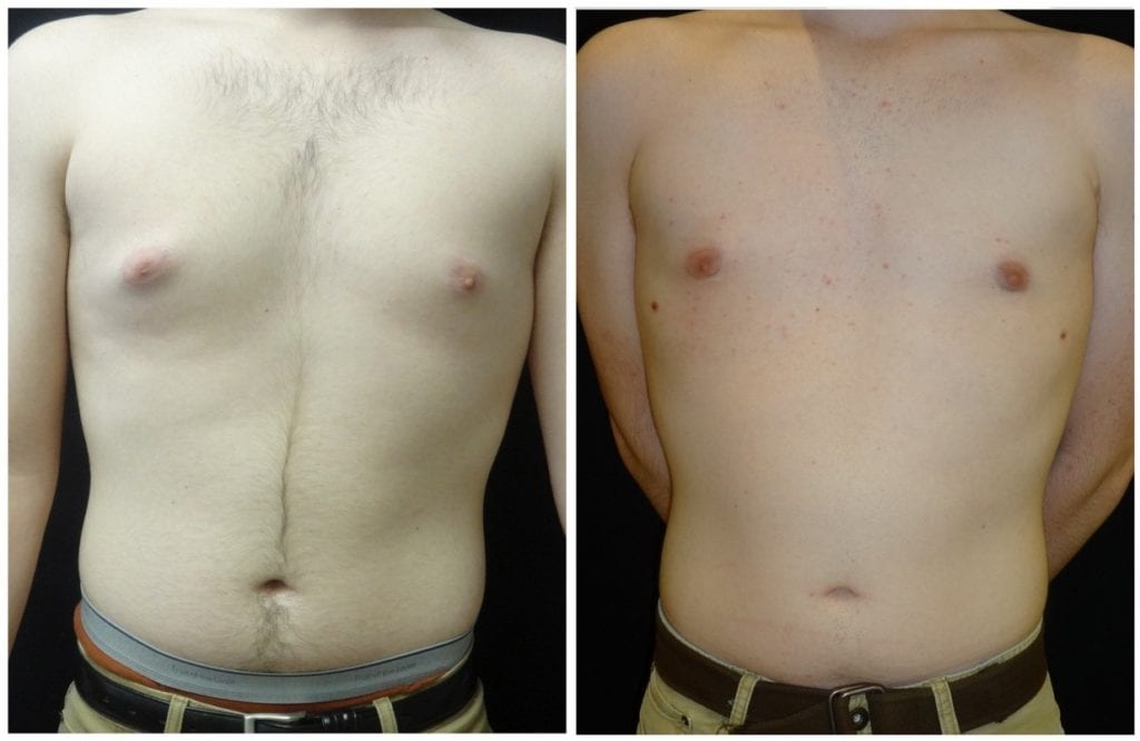 16589a-male-breast-reduction - Male Breast Reduction - Before And After - Gynecomastia - Fairfax and Manassas VA