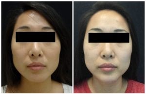 Non-Surgical Chin Augmentation - Before And After | Fairfax and Manassas VA