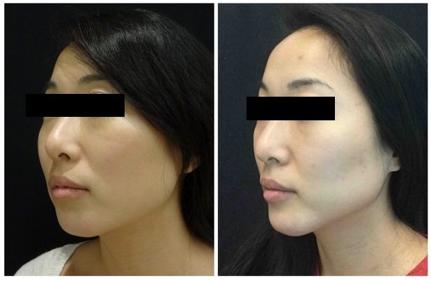 16620bb58dead79e0261-non-surgical-chin-augmentation - Non-Surgical Chin Augmentation - Before And After | Fairfax and Manassas VA
