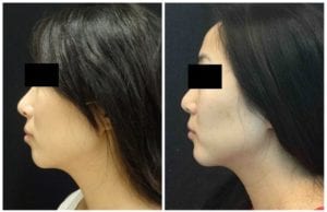 16620cc58dead7a03828-non-surgical-chin-augmentation - Non-Surgical Chin Augmentation - Before And After | Fairfax and Manassas VA