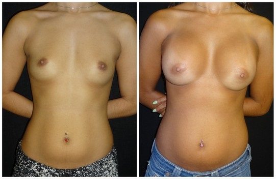 16649a-breast-augmentation - Breast Augmentation Before And After - Fairfax and Manassas VA