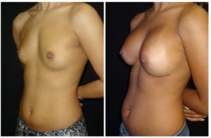 16649b-breast-augmentation - Breast Augmentation Before And After - Fairfax and Manassas VA