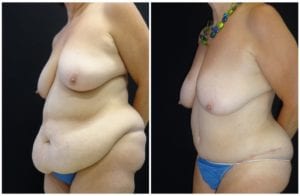 16704b53d15d0643b98-after-weight-loss - Body Contouring After Weight Loss - Before And After - Fairfax & Manassas VA