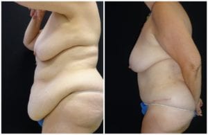 16704c53d15d0748480-after-weight-loss - Body Contouring After Weight Loss - Before And After - Fairfax & Manassas VA