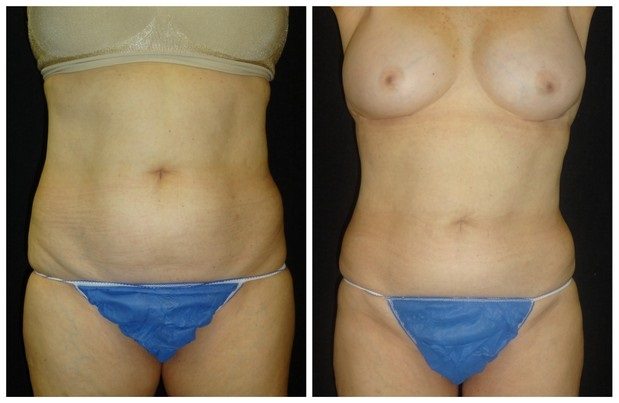 16851aa-coolsculpting - CoolSculpting - Before And After - Fairfax and Manassas VA