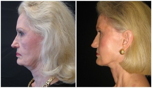 1693c-facelift - Facelift - Before And After Photos - Fairfax and Manassas VA