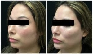 17073b58dead799f290-non-surgical-chin-augmentation - Non-Surgical Chin Augmentation - Before And After | Fairfax and Manassas VA