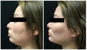 17073c58dead798b387-non-surgical-chin-augmentation - Non-Surgical Chin Augmentation - Before And After | Fairfax and Manassas VA