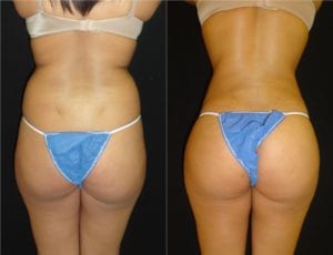 Brazilian Butt Lift - Before And After - Fairfax and Manassas VA