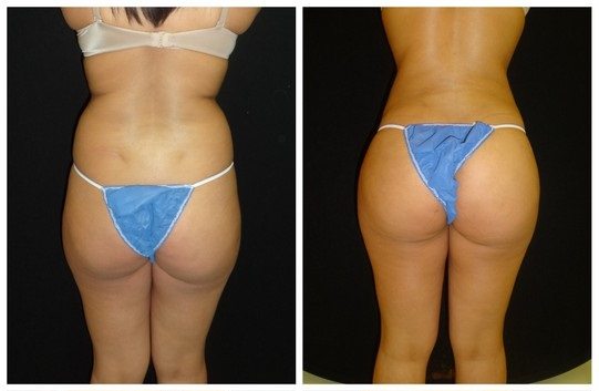 17168a-brazilian-butt-lift - Brazilian Butt Lift - Patient 01 - Before & After 1 | Fairfax and Manassas, VA
