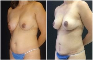 17246a-breast-lift - Breast Lift - Mastopexy Before And After - Fairfax and Manassas VA