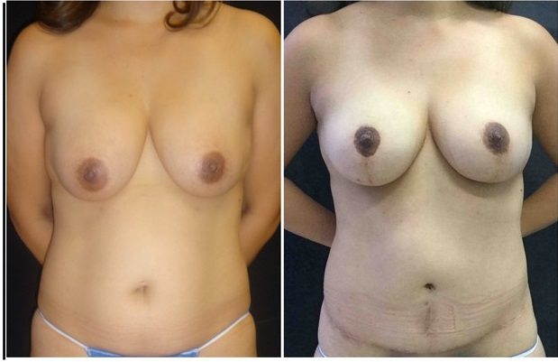 17246b-breast-lift - Breast Lift - Mastopexy Before And After - Fairfax and Manassas VA