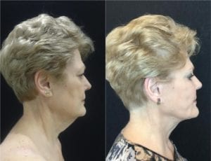 17468-20170329_Side2-facelift - Facelift - Before And After Photos - Fairfax and Manassas VA