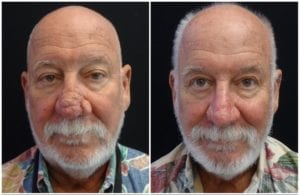 Rhinophyma Reduction - Before And After | Fairfax and Manassas VA