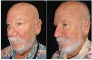 Rhinophyma Reduction - Before And After | Fairfax and Manassas VA
