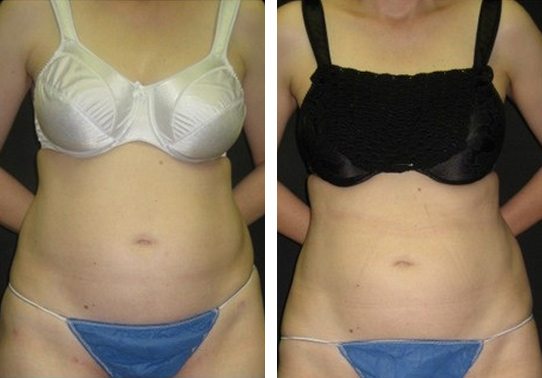 180-front-liposuction - Liposuction - Before And After - Fairfax and Manassas VA