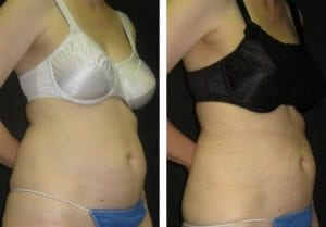 180-side-liposuction - Liposuction - Before And After - Fairfax and Manassas VA
