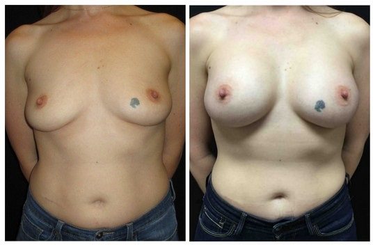 18038a-breast-augmentation - Breast Augmentation Before And After - Fairfax and Manassas VA
