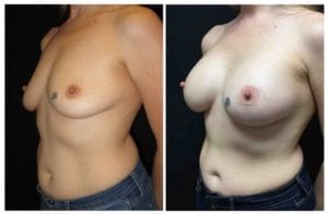18038b-breast-augmentation - Breast Augmentation Before And After - Fairfax and Manassas VA