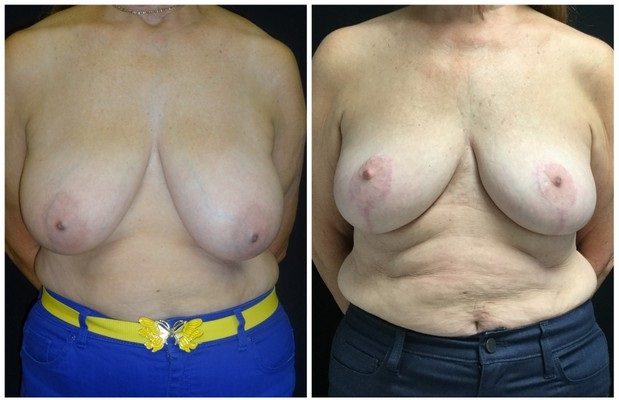 1818a-breast-reduction - Breast Reduction Before And After - Fairfax and Manassas VA