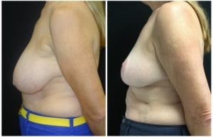 1818b-breast-reduction - Breast Reduction Before And After - Fairfax and Manassas VA