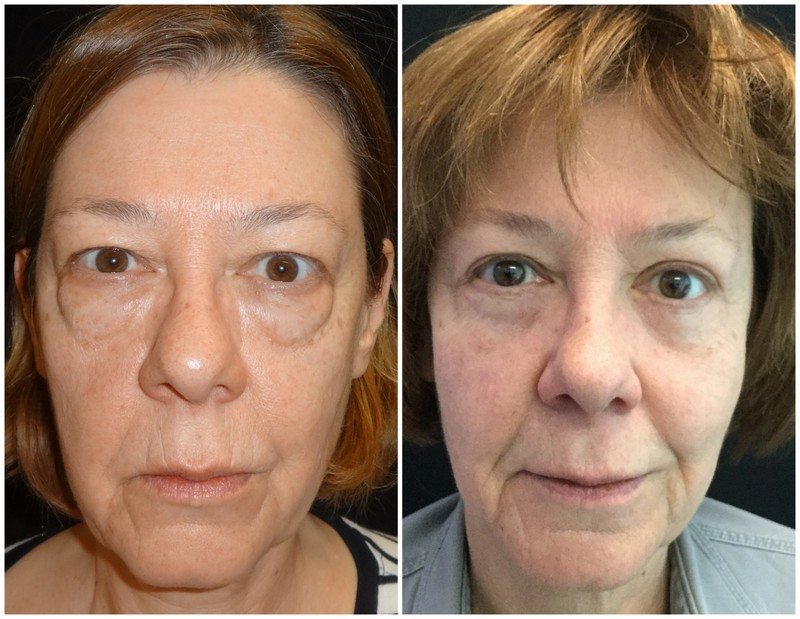 18361a-eyelid-lift-upper-and-lower - Upper and Lower Eyelid Lift - Before And After - Fairfax and Manassas VA