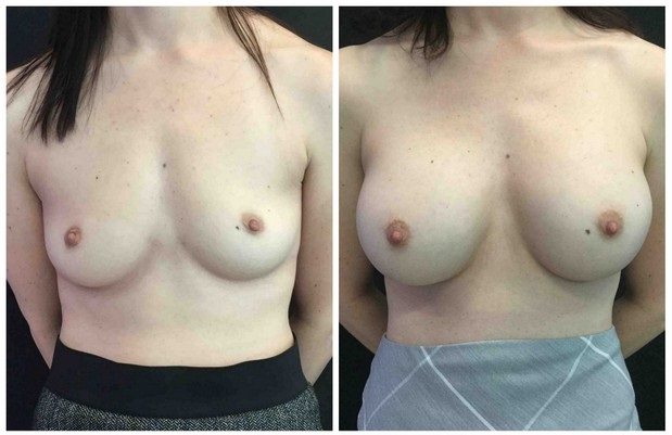 18513a-breast-augmentation - Breast Augmentation Before And After - Fairfax and Manassas VA