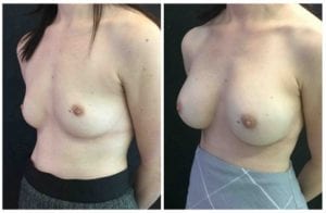 18513b-breast-augmentation - Breast Augmentation Before And After - Fairfax and Manassas VA